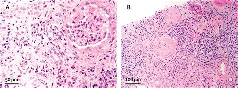 Igg4 Related Disease The Lancet