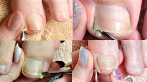 👣1 Pedicure Tutorial Big Toenail Cleaning Compilation Real Time 👣