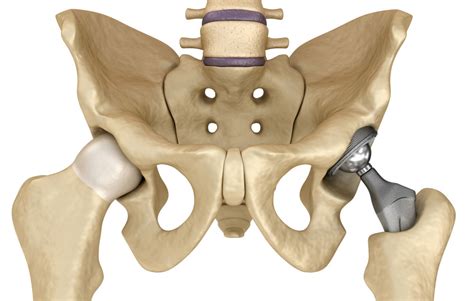 Guide To Hip Replacements