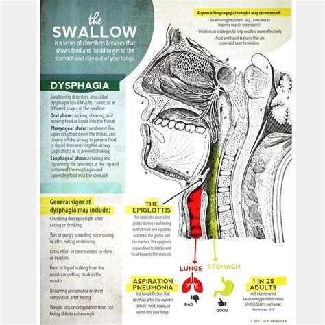 This Dysphagia Handout Provides A Quick Simple Visual Guide To The