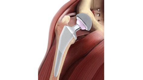 Hip Images Patient Education Resource Depuy Synthes