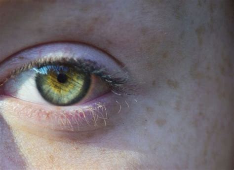24 Best Images About Central Heterochromia On Pinterest Green Halo