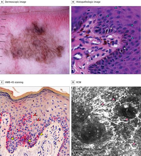 In Vivo Reflectance Confocal Microscopy For The Diagnosis Of Melanoma