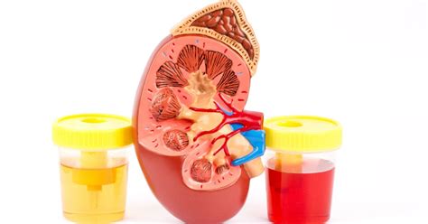 Hematuria Symptoms Diagnosis And Prevention Apollo Hospitals Blog