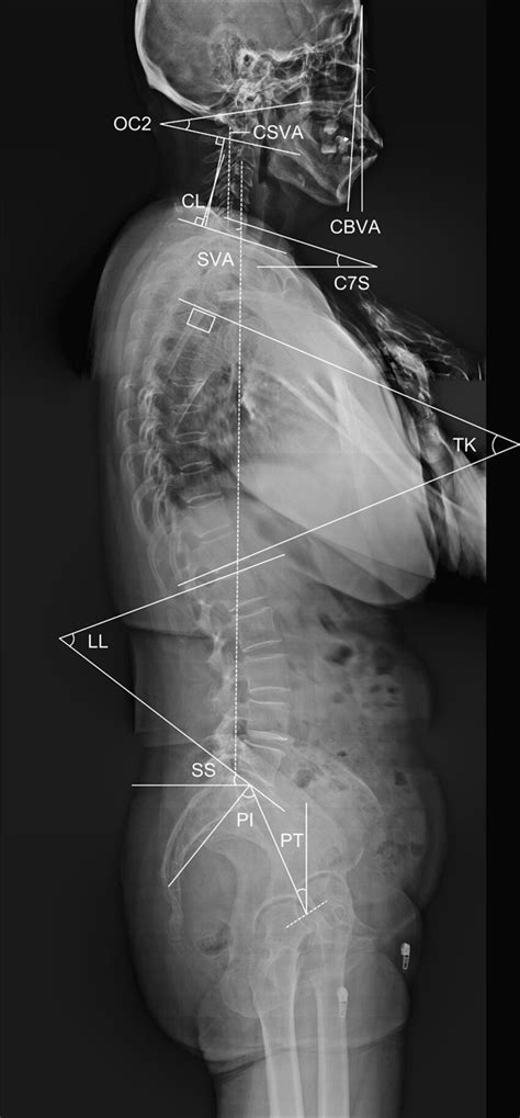 Measurements Of Spinal Sagittal Parameters Utilized In This Study