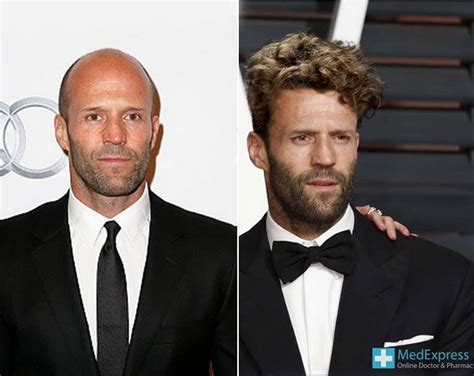 Male Celebrities Get Hair Transplants Ok Magazine