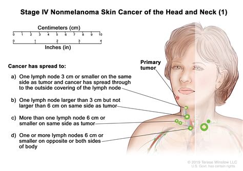 Neck Lymph Node Cancer