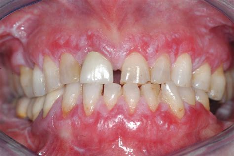 Leukoplakia On Gums Pictures Photos