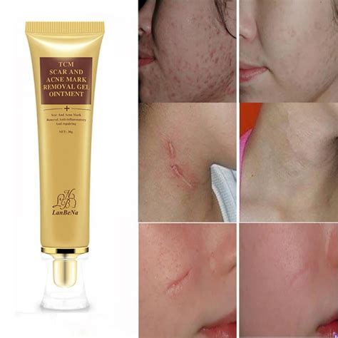 30g Scar Acnes Keloid Repairs Stretch Gel Cream Marks Skin Burns
