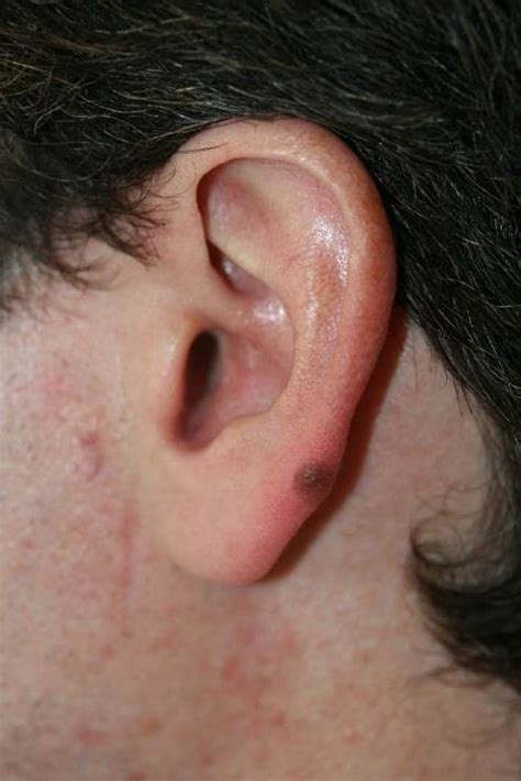 Skin Cancer On Ear Best Life And Health Tips And Tricks