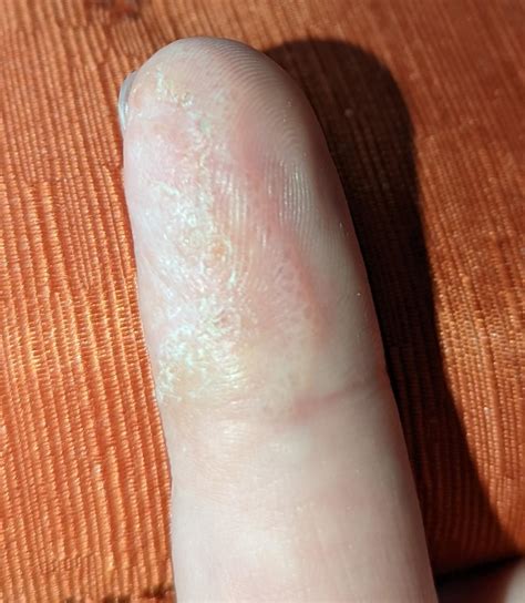 I Definitely Have Dyshidrosis On My Hands But Is It On The Bottom Of