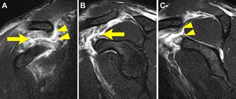 Grade 3 Acromioclavicular Injury Complete Tearing Of Coracoclavicular