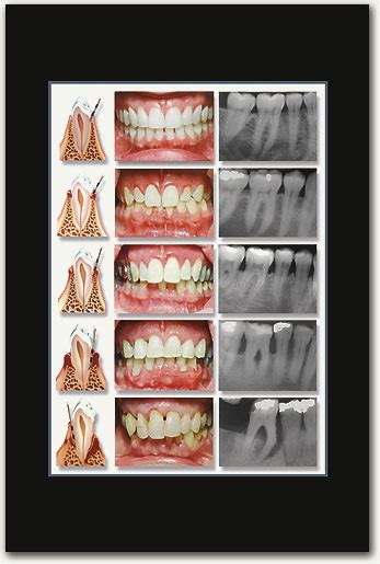 Stages Of Perio Poster Smartpractice Dental