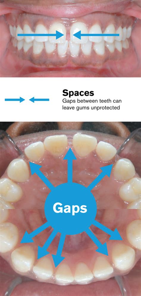 Nowadays there are also various ways to fix these dental gaps. How To Close A Gap In Your Teeth With Braces - TeethWalls