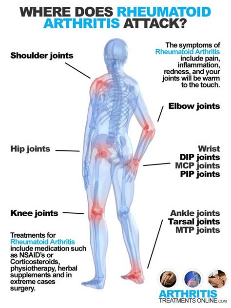 Hip Joint Pain Location Chart