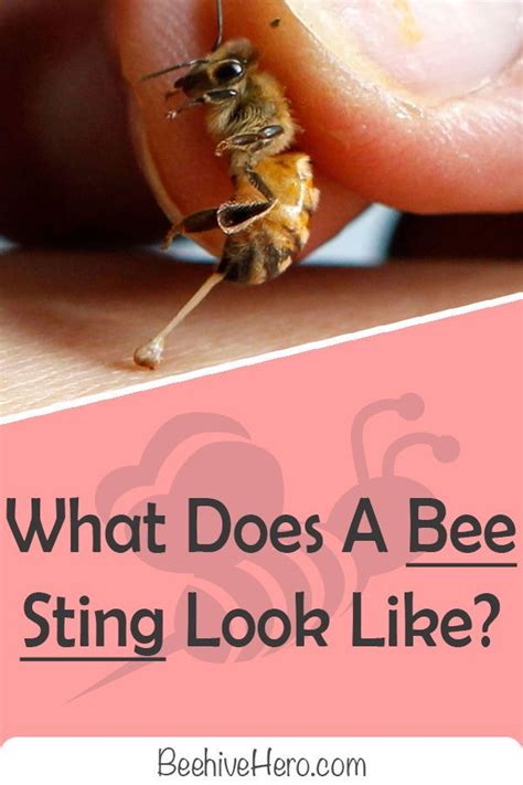 What Does A Bee Sting Look Like A Visual Guide Bee Sting Bee Bee