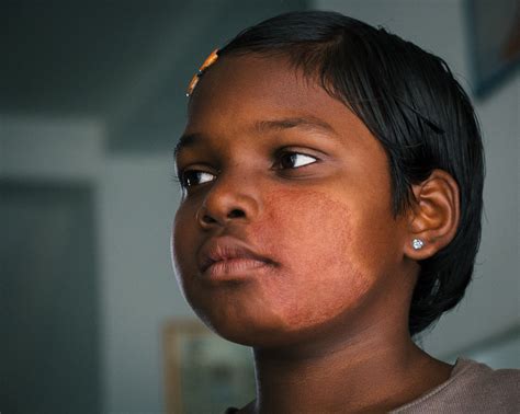 Ed Hanley: Documenting Leprosy in India