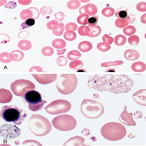 Thalassemia Target Cells What Is The Howell Jolly Body Stanford