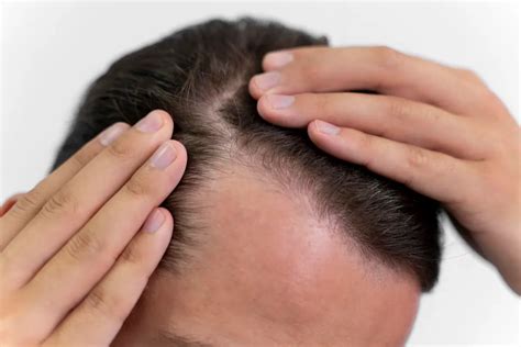 Types Of Hair Loss In Men Women By Hairtransplantation