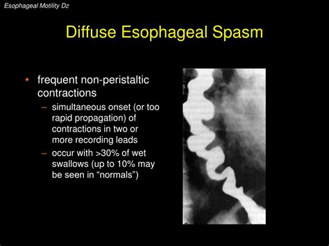 PPT Esophageal Motility Disorders PowerPoint Presentation Free