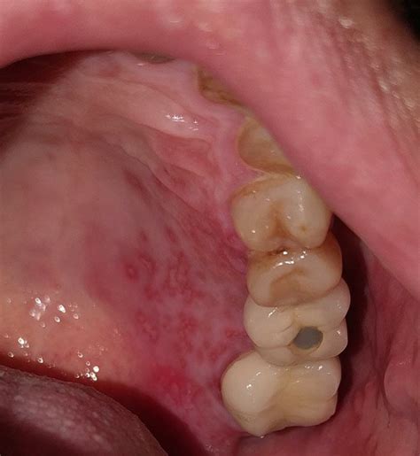 List 94 Images What Do Ulcers On The Tongue Look Like Sharp