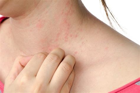 Dermatite Atopica Cos Cause E Come Curarla Ohga