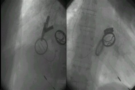 Transvenous Right Ventricular Pacing In A Patient With Tricuspid