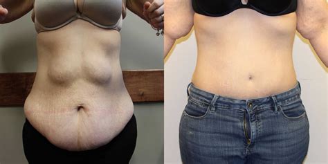 The Best What Is Mini Tummy Tuck Before And After Photos Inspireya