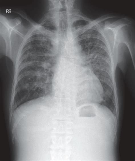 A Chest X Ray Bilateral Hilar Lymphadenopathy B C Ct