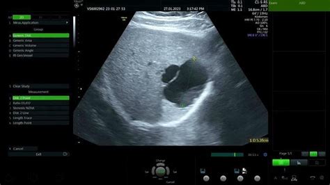 Cyst Liver Ultrasound