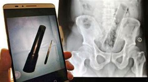 Man With Heavy Duty Torch Stuck Up His Bottom Refuses To Tell Doctors