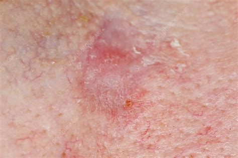 Treated Skin Cancer On Cheek Stock Image C0151230 Science Photo