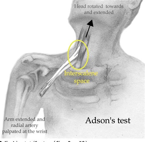 Figure 4 From Thoracic Outlet Syndrome Semantic Scholar
