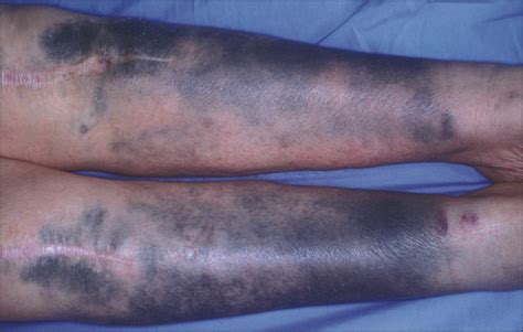 Blue Black Pigmentation Of Legs And Arms In A 68 Year Old Woman—quiz