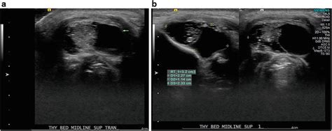 Sonographic Appearance Of Abnormal Cervical Lymph Nodes In The