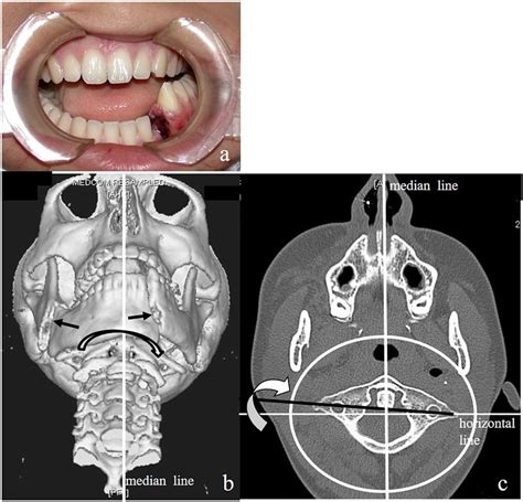 Bilateral Displaced Mandibular Fractures A Clinical View B