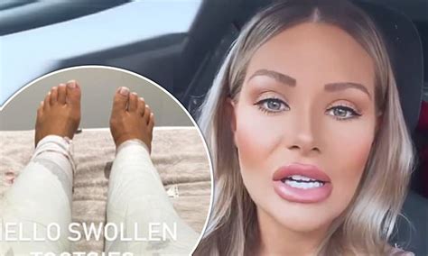 Love Islands Shaughna Phillips Confirms Shes Had Lipo On Her Legs To