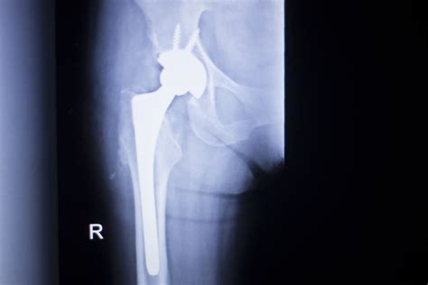 Stryker Metal On Metal Hip Implant Lawsuits Consolidated Parker