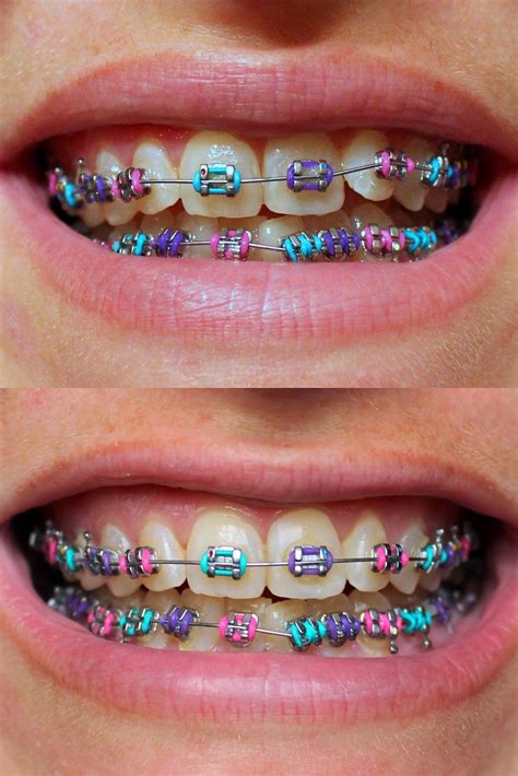 Red And Green Braces Colors Anh Salinas