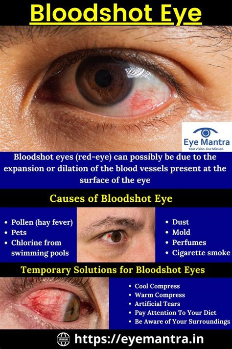 Bloodshot Eye Over The Counter Solutions For Red Eye Bloodshot Eyes