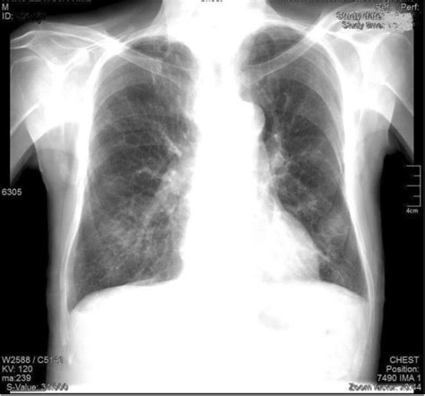 Chest X Ray Posteroanterior Pa View Showing Non Homogenous