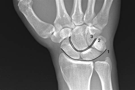Dislocation Wrist Radiocarpal Hand Surgery Source