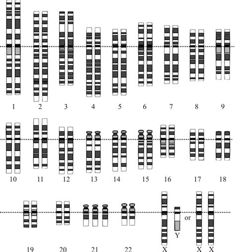 Down syndrome is a condition that occurs when a baby is born with an extra chromosome. File:Down Syndrome Karyotype.png - Wikimedia Commons
