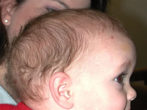 Dolichocephaly Definition Pictures Symptoms Causes Treatment