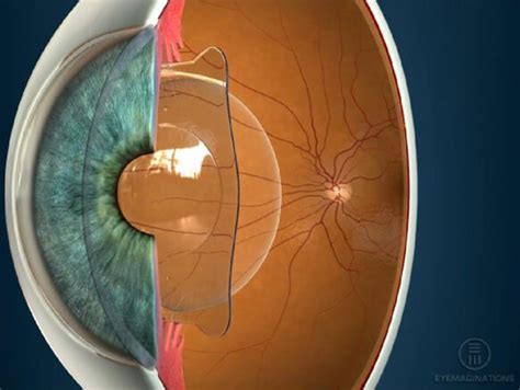 Implantable Collamer Lens Icl Melbourne Eye Centre