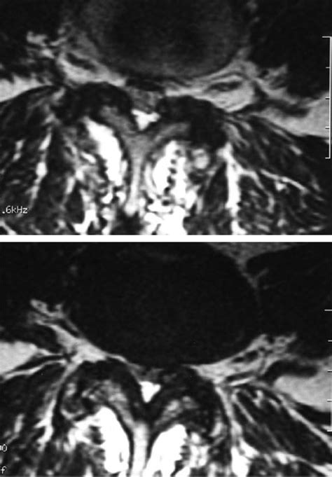 Lumbar Intraspinal Synovial Cyst Containing Gas As A Cause For Low Back