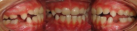 Early Treatment Of Anterior Crossbite Relating To Functional Class Iii
