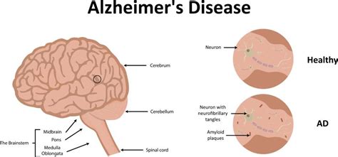 Breakthrough Study On The Cause Of Alzheimers Premier Neurology