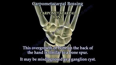 Check spelling or type a new query. Carpometacarpal Bossing - Everything You Need To Know - Dr ...