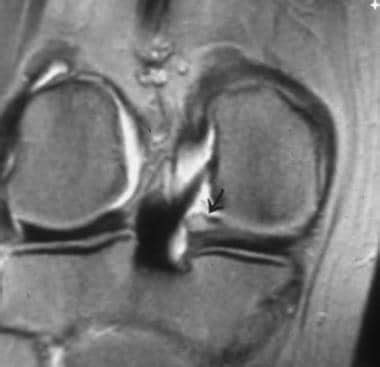 Meniscal Tears On Mri Overview Anatomy Descriptions And Classifications